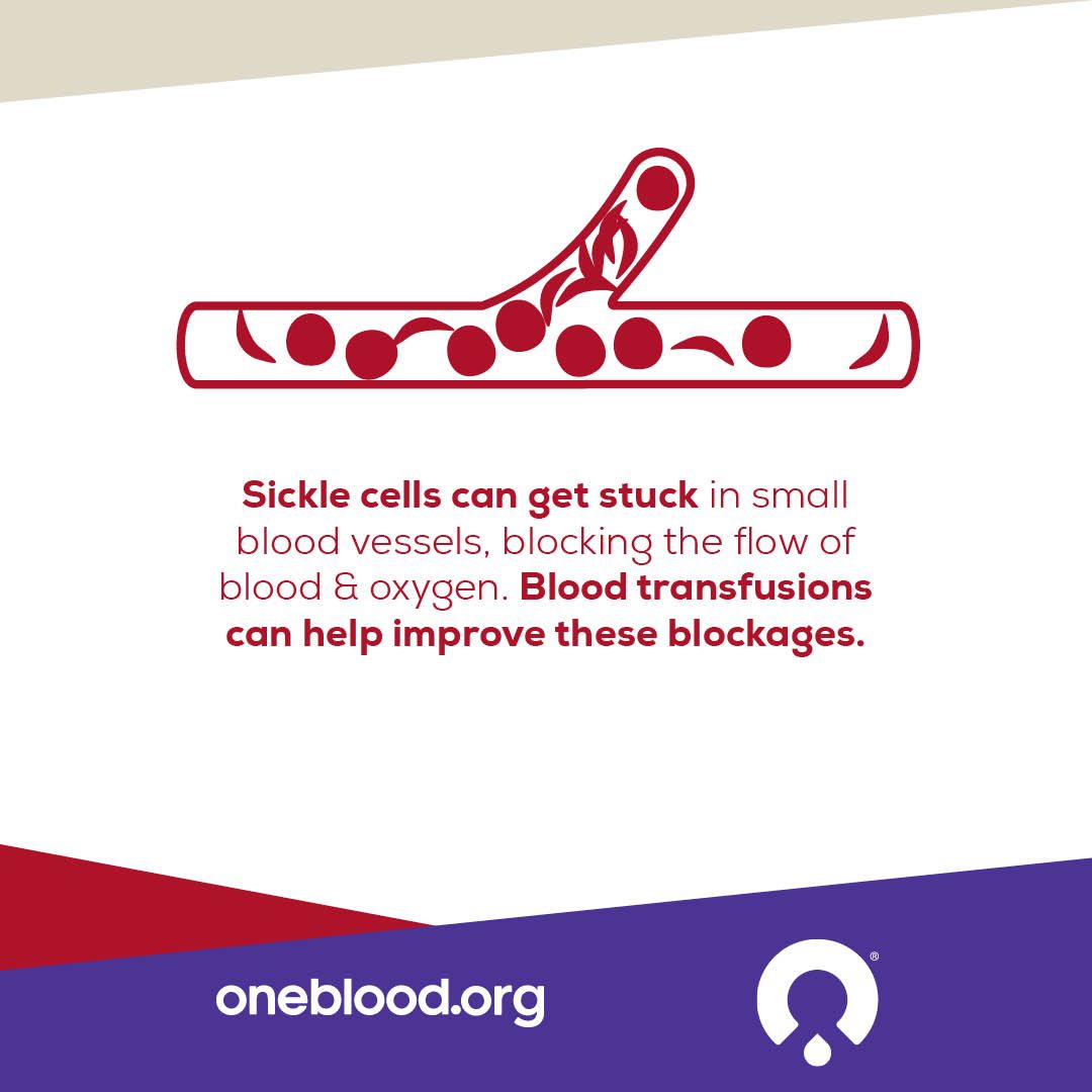 Sickle Cell info graphic reads, “Sickle cells can get stuck in small blood vessels, blocking the flow of blood & oxygen. Blood transfusions can help improve these blockages.” 