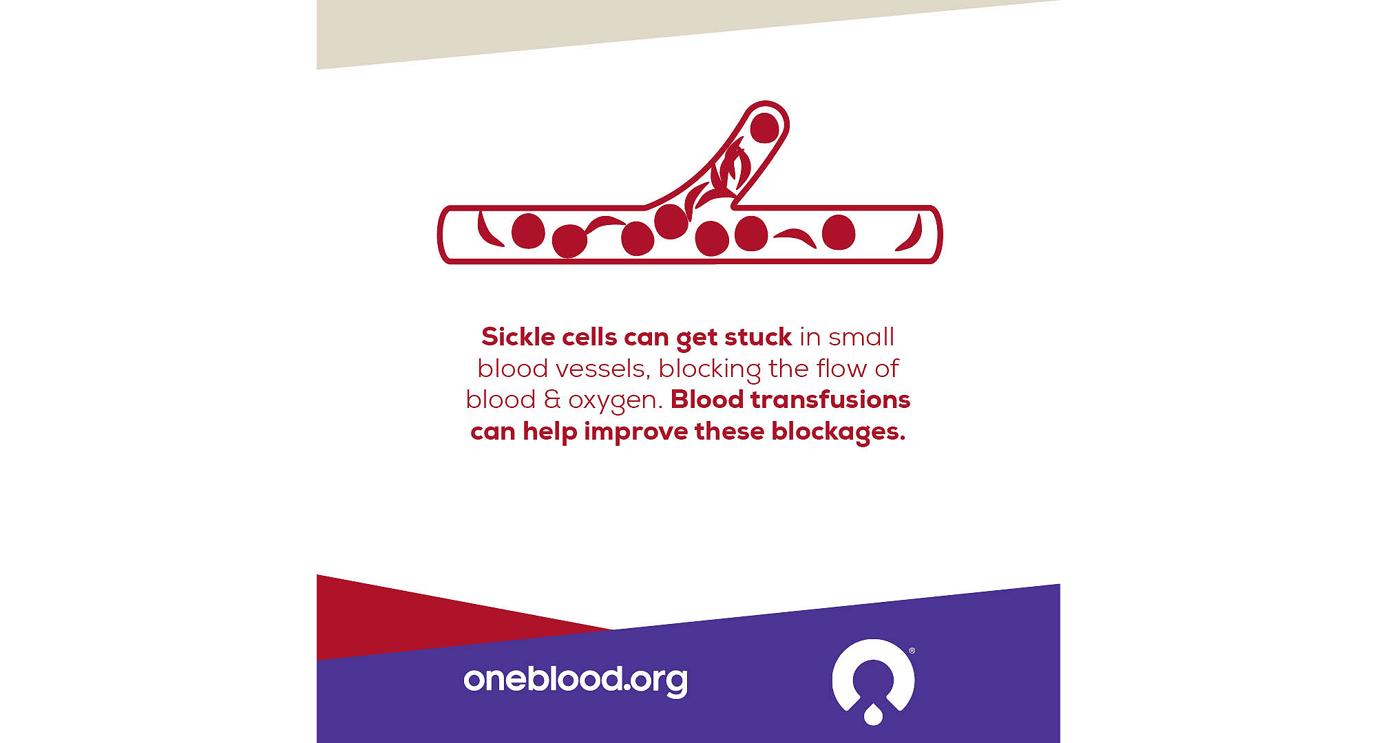 Sickle Cell info graphic reads, “Sickle cells can get stuck in small blood vessels, blocking the flow of blood & oxygen. Blood transfusions can help improve these blockages.” 