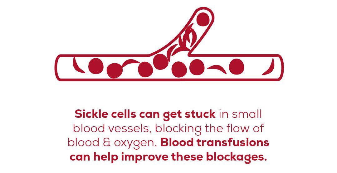 Illustration of what happens to sickle cells in a blood vessel in people with sickle cell disease.
