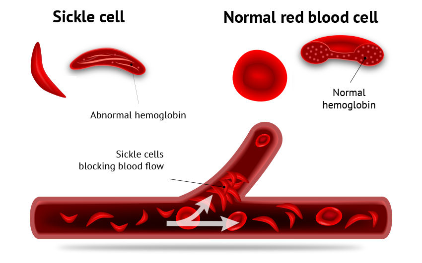 Sickle cell and normal red blood cell graphic