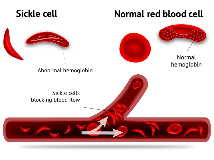 Sickle cell and normal red blood cell graphic